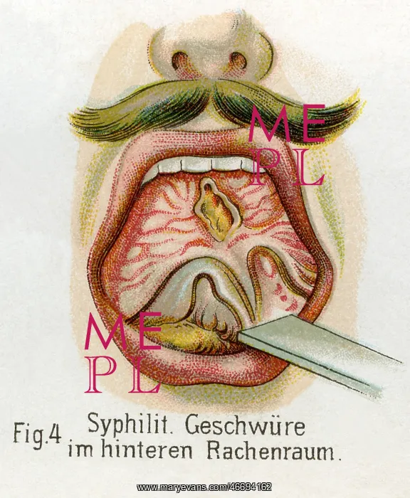  : Syphilitic blains in throat, 1902
