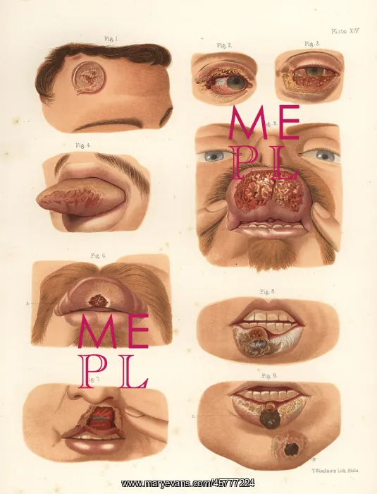 : Syphilitic chancres on the face : Syphilitic chancres on the face