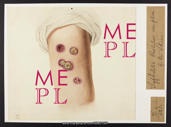 : Syphilitic Pustular Eruption of Skin : Syphilitic Pustular Eruption of Skin