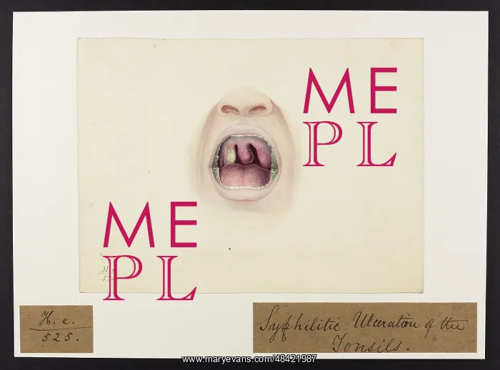 : Syphilitic Ulcerations of Tonsils : Syphilitic Ulcerations of Tonsils
