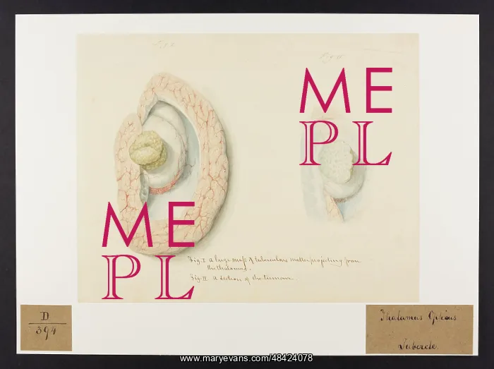  : Thalmus Opticus: Tubercle