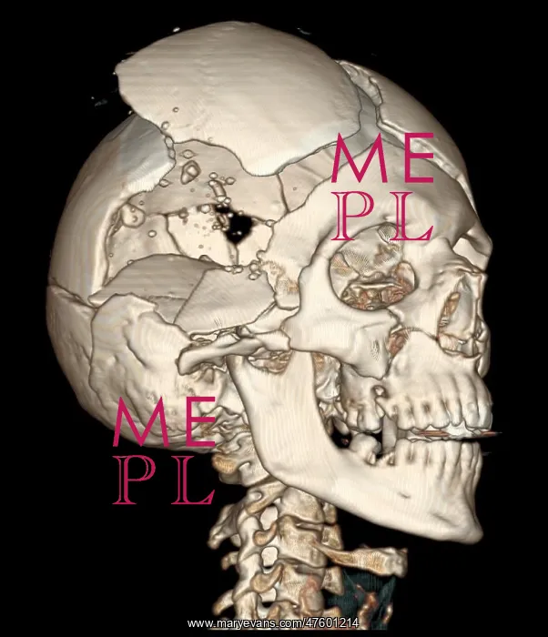 : Three-Dimensional CT Reconstruction, Skull with Bullet Wound : Three-Dimensional CT Reconstruction, Skull with Bullet Wound