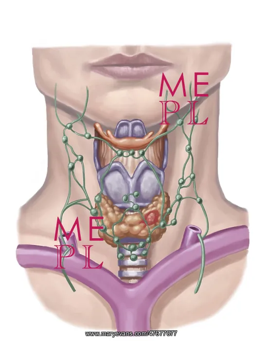 : Thyroid Nodule, Illustration : Thyroid Nodule, Illustration
