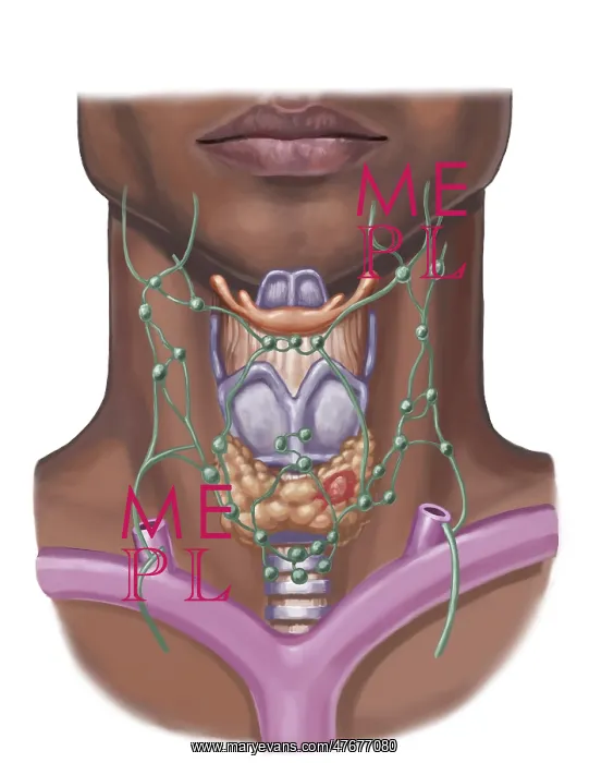 : Thyroid Nodule, Illustration : Thyroid Nodule, Illustration