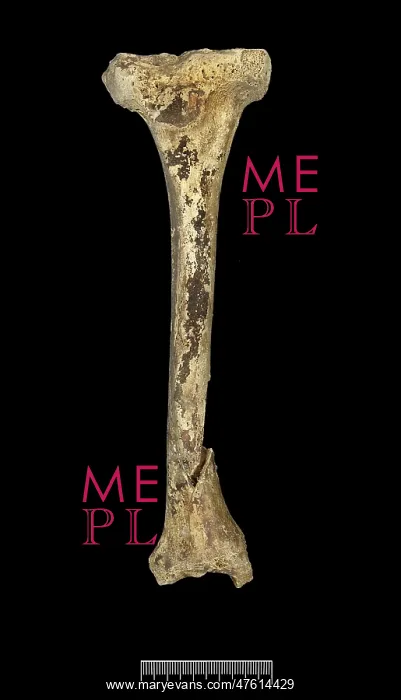 : Tibia of Achondroplastic Dwarf : Tibia of Achondroplastic Dwarf