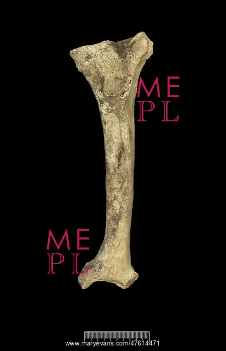: Tibia of Achondroplastic Dwarf : Tibia of Achondroplastic Dwarf
