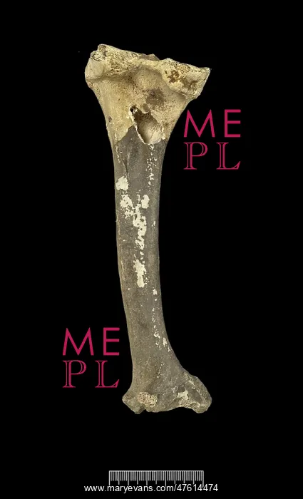 : Tibia of Achondroplastic Dwarf : Tibia of Achondroplastic Dwarf