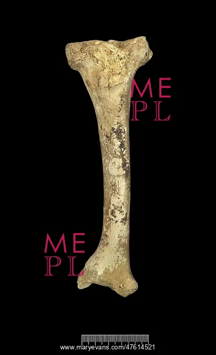 : Tibia of Achondroplastic Dwarf : Tibia of Achondroplastic Dwarf