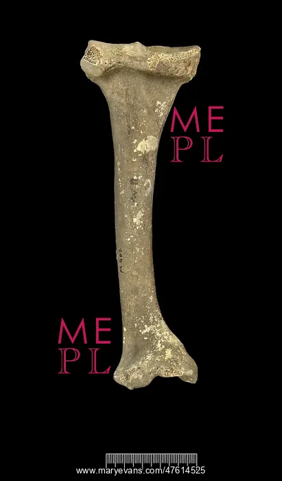 : Tibia of Achondroplastic Dwarf : Tibia of Achondroplastic Dwarf