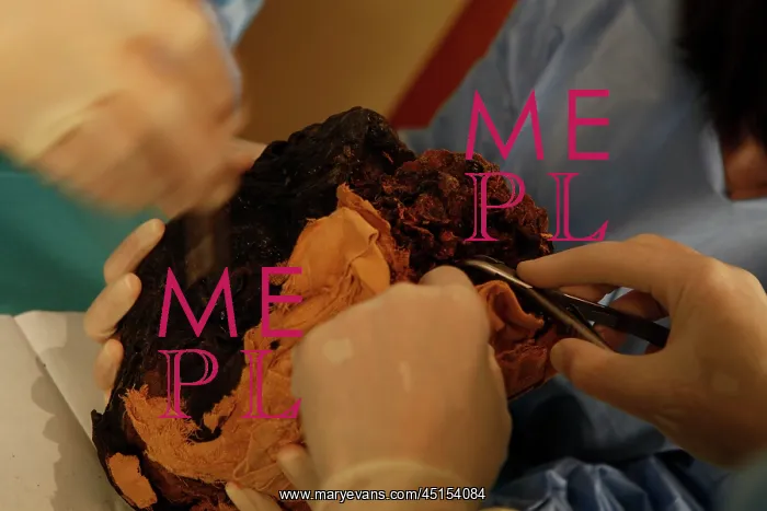 : Tissue sampling operation of an Egyptian mummy : Tissue sampling operation of an Egyptian mummy
