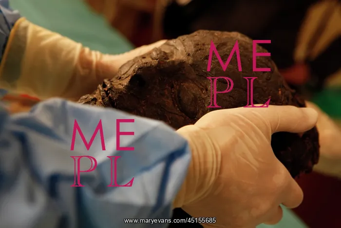 : Tissue sampling operation of an Egyptian mummy : Tissue sampling operation of an Egyptian mummy