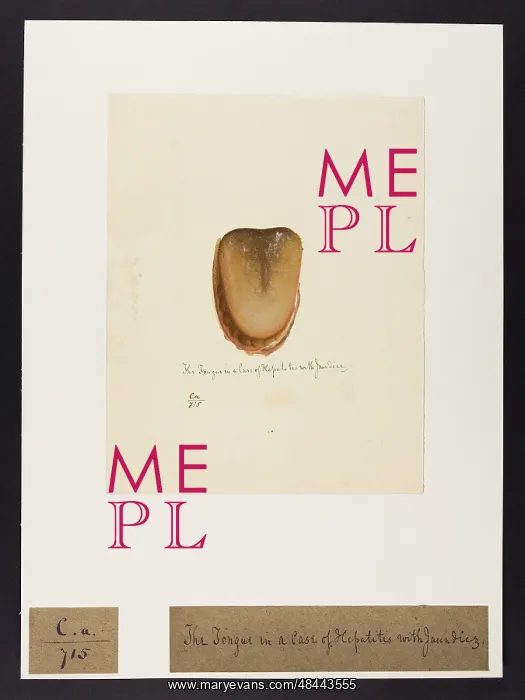 : The Tongue in a Case of Hepatitis : The Tongue in a Case of Hepatitis