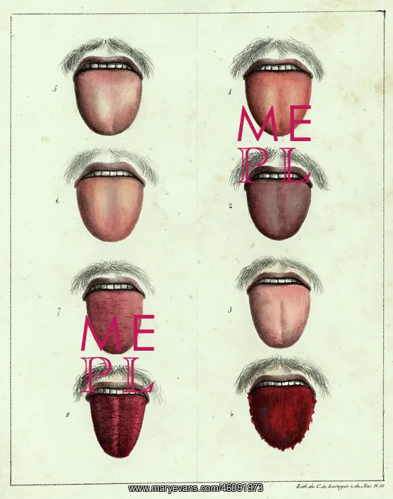: The tongue of a yellow fever sufferer : The tongue of a yellow fever sufferer