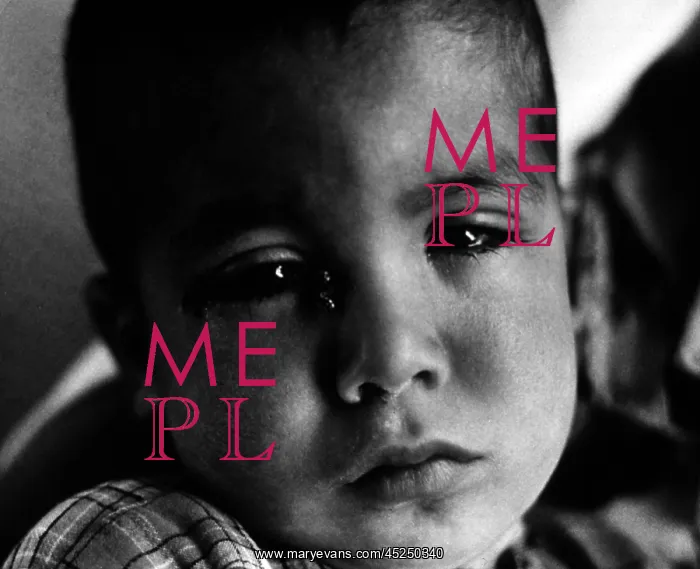 : Trachoma. A young a young child with flies around : Trachoma. A young a young child with flies around