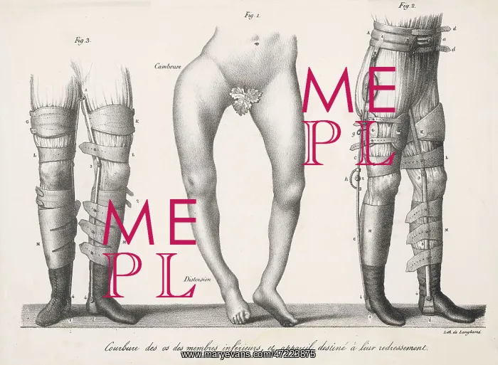 : TREATING BOW LEGS (2) : TREATING BOW LEGS (2)