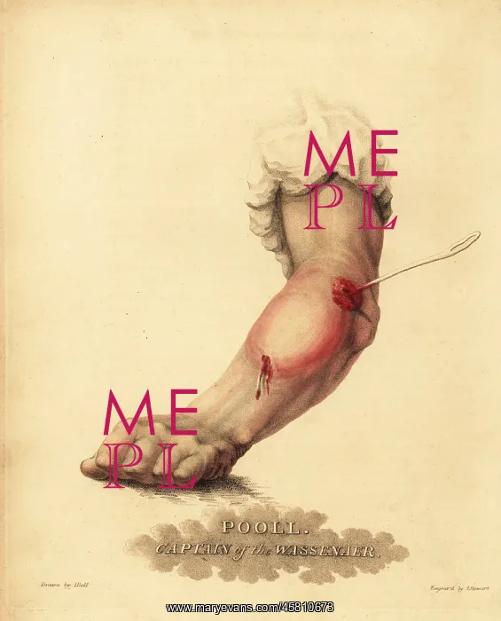 : Treatment of an abscess in the forearm, 1815 : Treatment of an abscess in the forearm, 1815