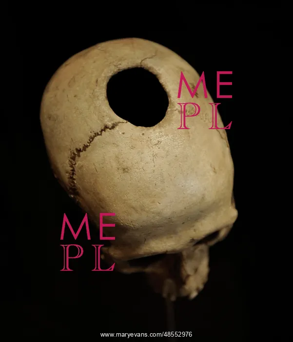 : Trepanned skull. Neolithic Period. Denmark : Trepanned skull. Neolithic Period. Denmark