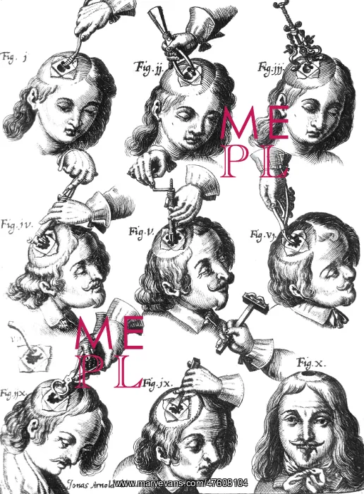 : Trepanning, 1666 : Trepanning, 1666