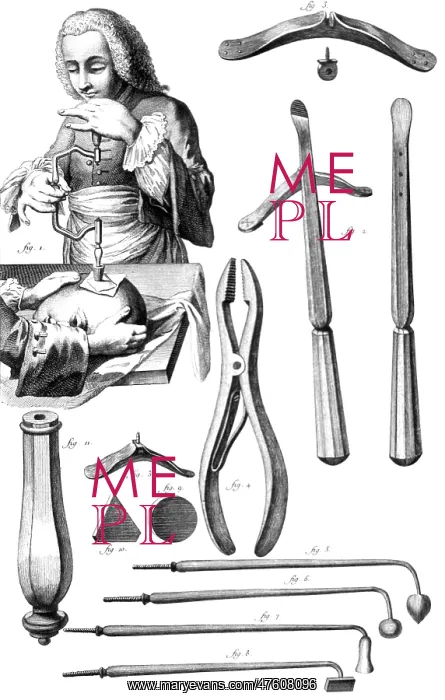 : Trepanning, 1772 : Trepanning, 1772