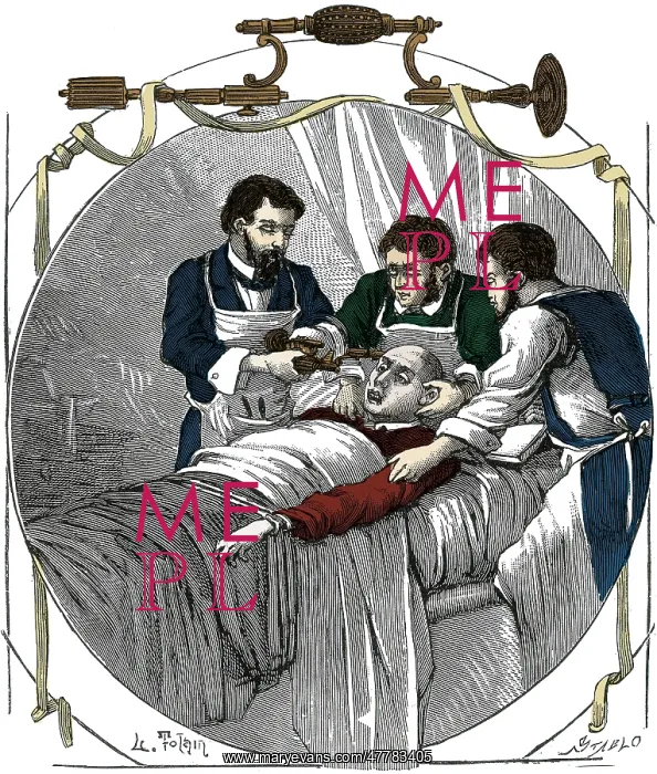  : Trepanning, 19th Century