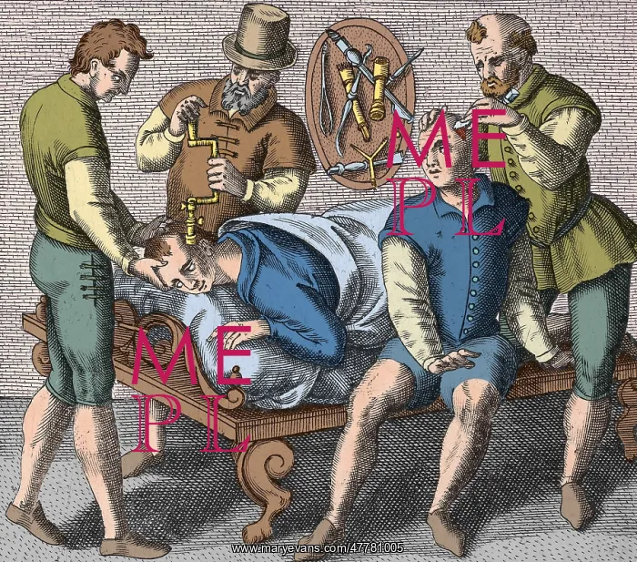 : Trepanning Being Performed, 1594 : Trepanning Being Performed, 1594
