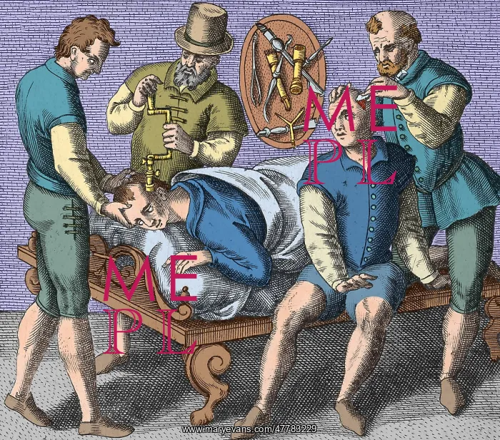 : Trepanning Being Performed, 1594 : Trepanning Being Performed, 1594