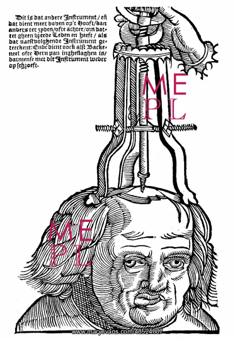 : Trephination: Using an elevator to remove piece : Trephination: Using an elevator to remove piece