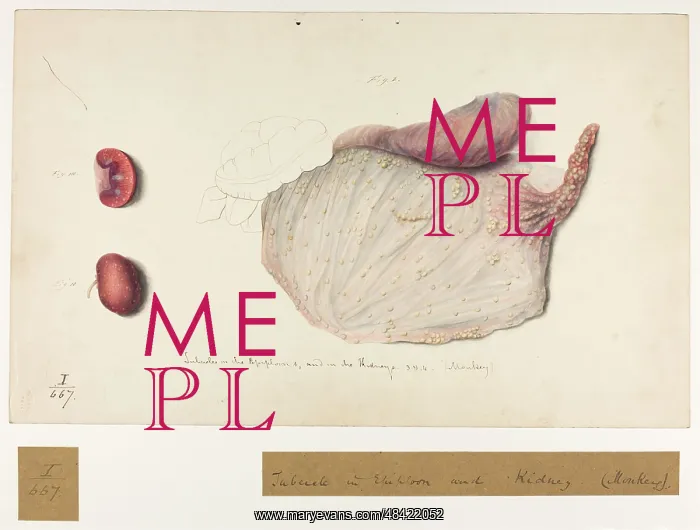 : Tubercle in Epiploon and Kidney. (Monkey) : Tubercle in Epiploon and Kidney. (Monkey)