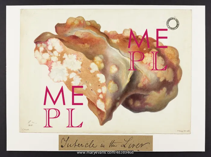 : Tubercle in the Liver : Tubercle in the Liver