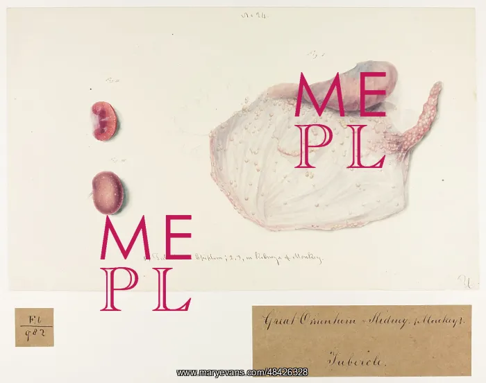 : Tubercles in Epiploon, Kidneys of Monkey : Tubercles in Epiploon, Kidneys of Monkey