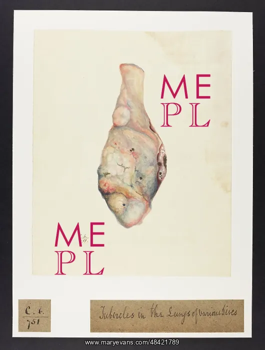 : Tubercles in Lungs : Tubercles in Lungs