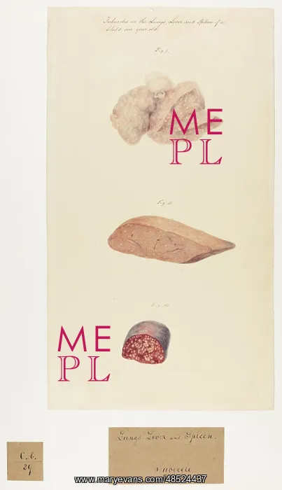 : Tubercles in the Lungs, Liver and Spleen : Tubercles in the Lungs, Liver and Spleen