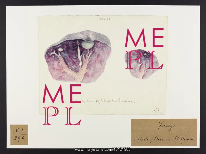 : Tubercles and Modes of Cure: Tubercular Phthisis : Tubercles and Modes of Cure: Tubercular Phthisis