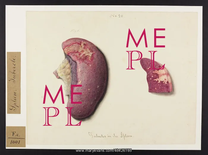 : Tubercles in the Spleen : Tubercles in the Spleen