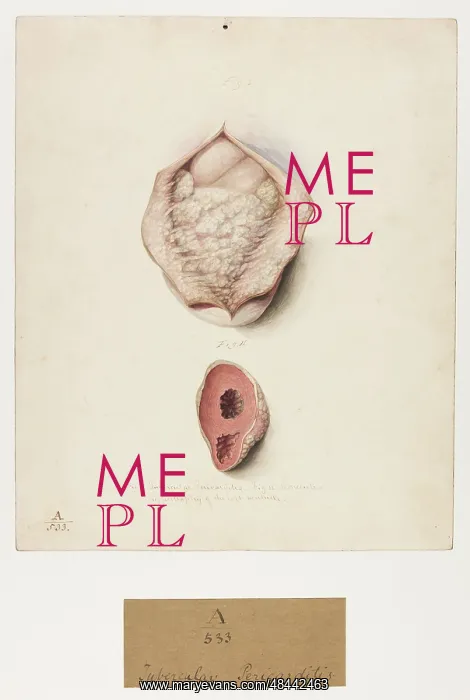 : Tubercular pericarditis : Tubercular pericarditis