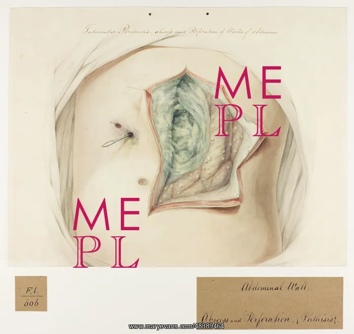 : Tubercular Peritonitis, Abscess, Perforation of the Abdomen : Tubercular Peritonitis, Abscess, Perforation of the Abdomen