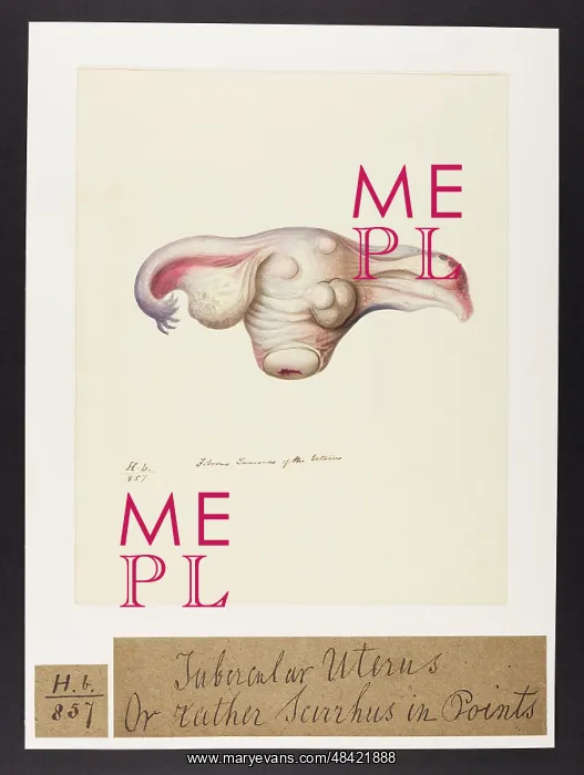 : Tubercular Uterus, Scirrhus in Points : Tubercular Uterus, Scirrhus in Points