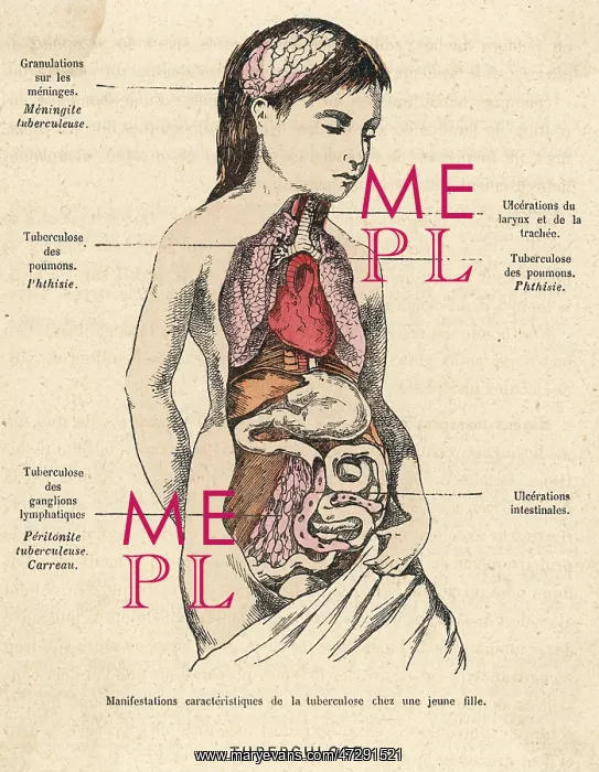 : TUBERCULOSIS SUFFERER : TUBERCULOSIS SUFFERER