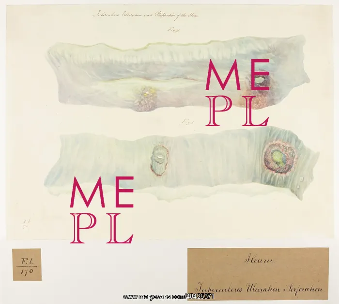 : Tuberculous Ulceration and Perforation of the Ileum : Tuberculous Ulceration and Perforation of the Ileum