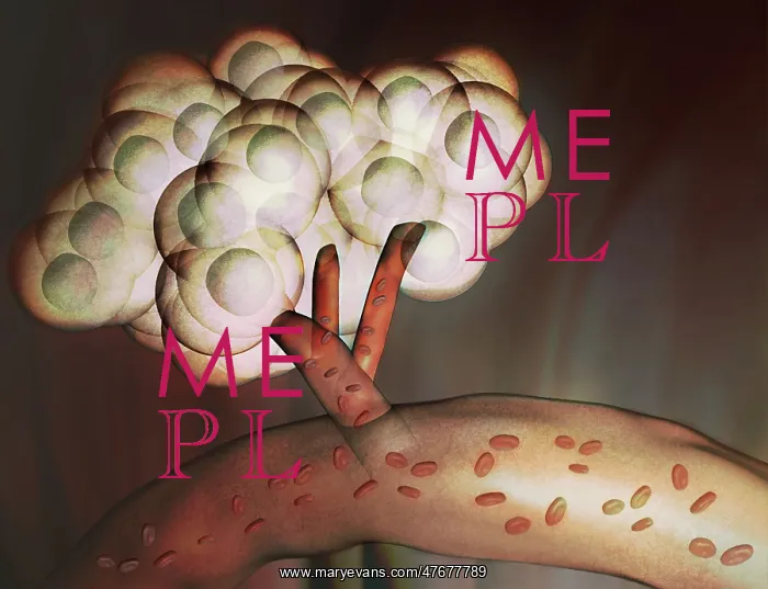 : Tumor, Illustration : Tumor, Illustration