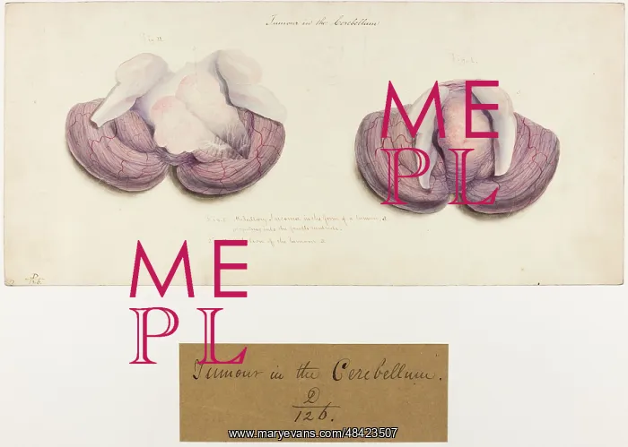 : Tumour in the cerebellum : Tumour in the cerebellum