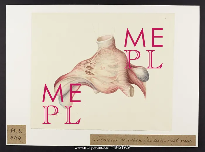 : Tumour: Sacrum and Uterus : Tumour: Sacrum and Uterus