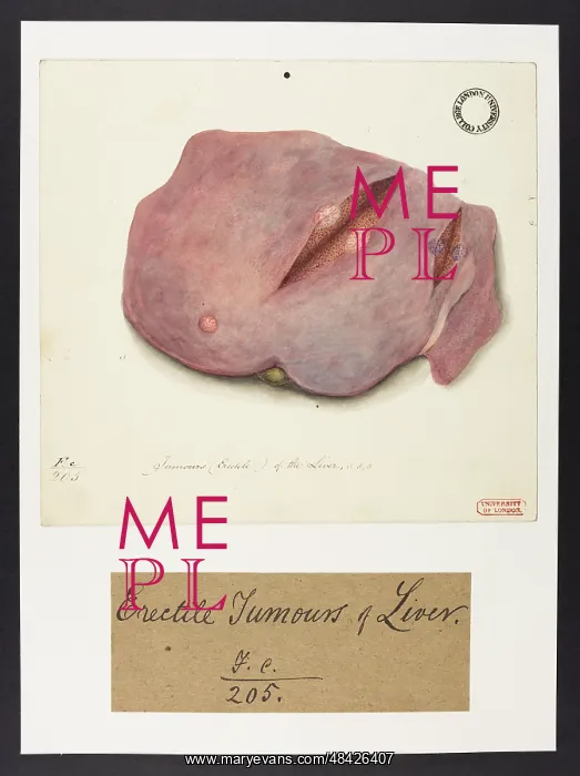 : Tumours of the Liver : Tumours of the Liver
