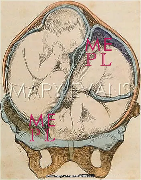  : TWINS IN THE WOMB