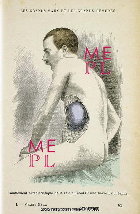 : Typical enlarged spleen of a Malaria patient : Typical enlarged spleen of a Malaria patient
