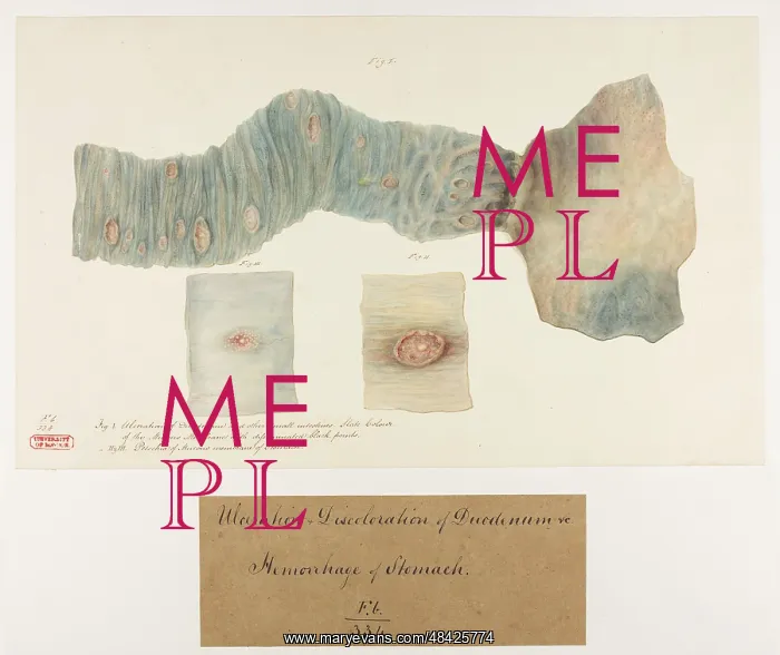 : Ulceration and Discolouration of Duodenum : Ulceration and Discolouration of Duodenum