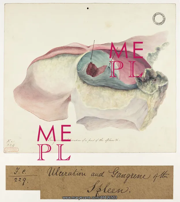 : Ulceration and Gangrene of a part of the Spleen : Ulceration and Gangrene of a part of the Spleen