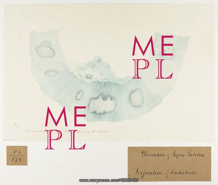 : Ulceration of the Glandulae Peyeri : Ulceration of the Glandulae Peyeri