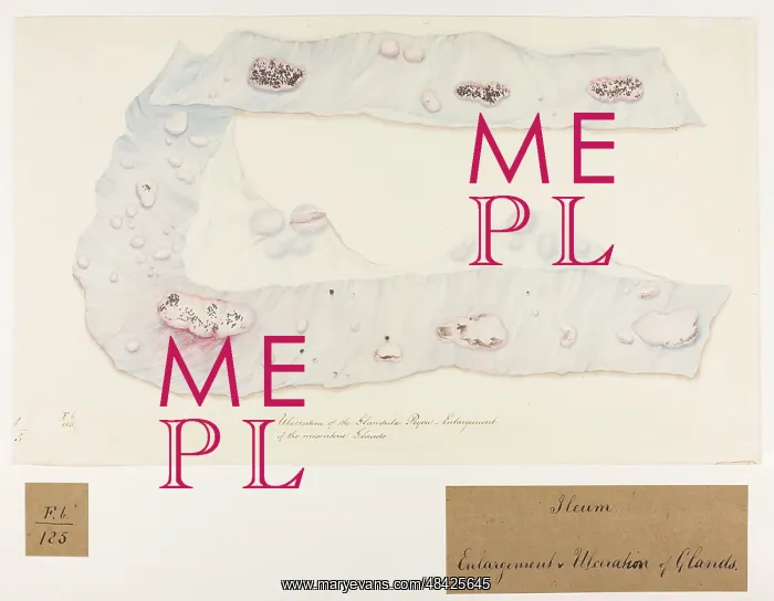 : Ulceration of the Glandulae Peyeri : Ulceration of the Glandulae Peyeri