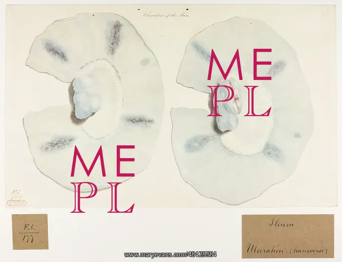 : Ulceration of the Ileon : Ulceration of the Ileon